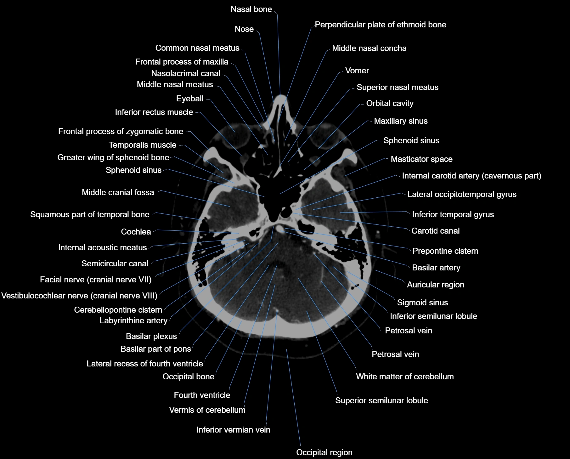 CT scan brain axial labelled cross sectional anatomy image-img-000017.webp